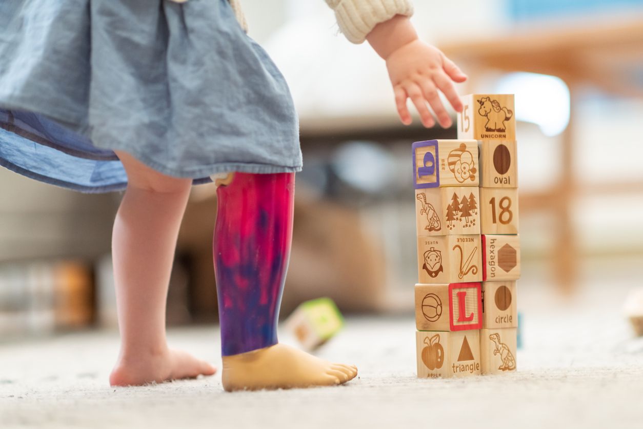 Child with prosthetic leg